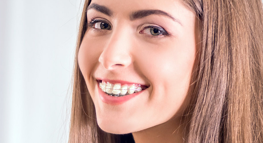 How Long do Clear Braces Take? - Fine Orthodontics